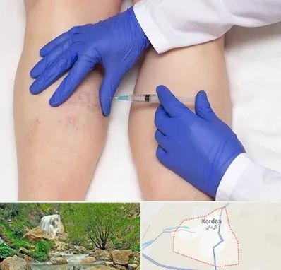 اسکلروتراپی در کردان