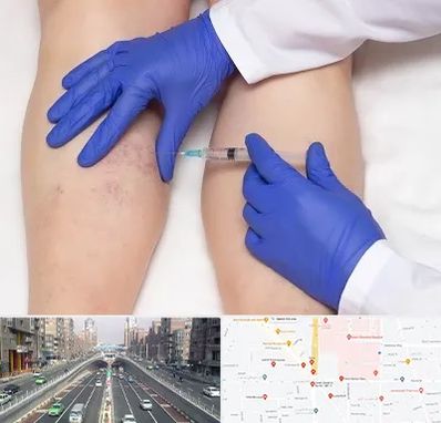 اسکلروتراپی در توحید 