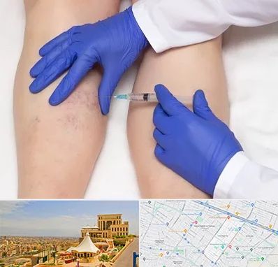 اسکلروتراپی در هاشمیه مشهد