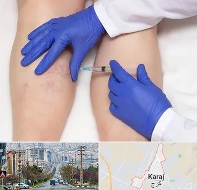 اسکلروتراپی در گوهردشت کرج 