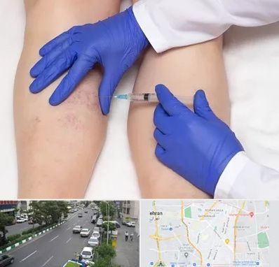 اسکلروتراپی در ستارخان 