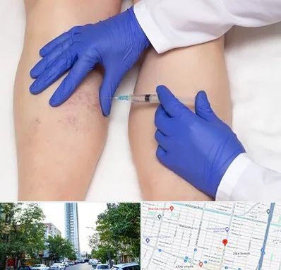 اسکلروتراپی در امامت مشهد