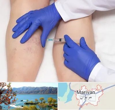 اسکلروتراپی در مریوان
