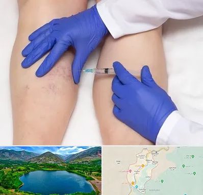 اسکلروتراپی در رودبار