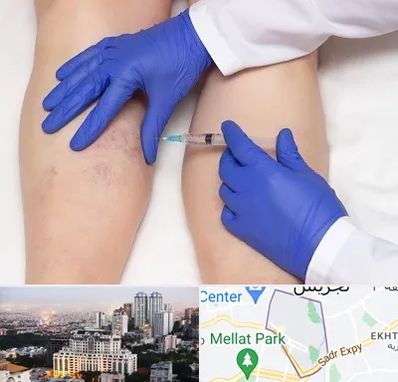 اسکلروتراپی در الهیه 