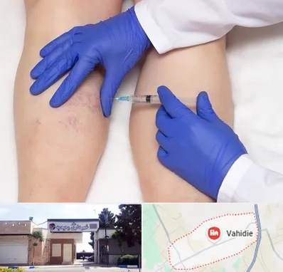 اسکلروتراپی در وحیدیه شهریار