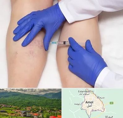 اسکلروتراپی در آمل