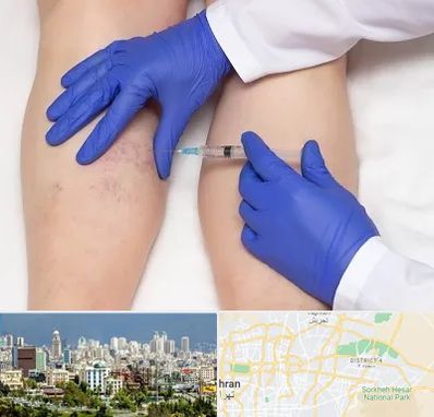 اسکلروتراپی در شرق تهران 