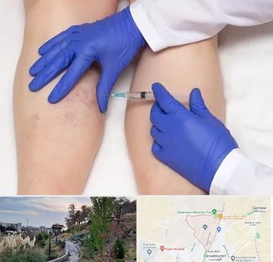 اسکلروتراپی در باغستان کرج