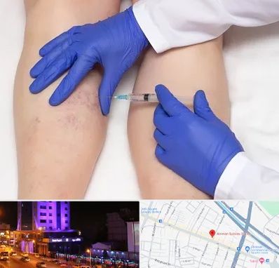 اسکلروتراپی در آبرسان تبریز