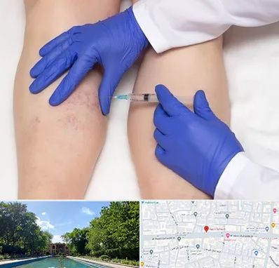 اسکلروتراپی در هشت بهشت اصفهان