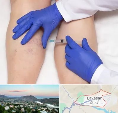 اسکلروتراپی در لواسان