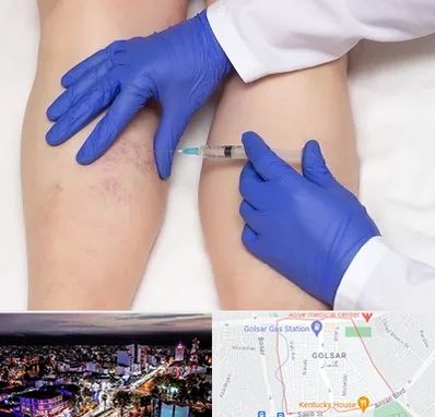 اسکلروتراپی در گلسار رشت 