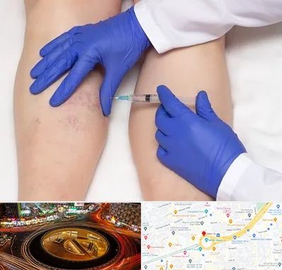 اسکلروتراپی در میدان ولیعصر 