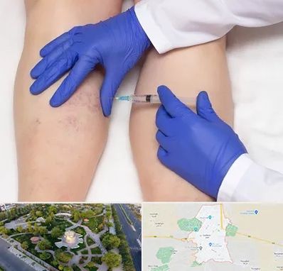 اسکلروتراپی در کاشمر