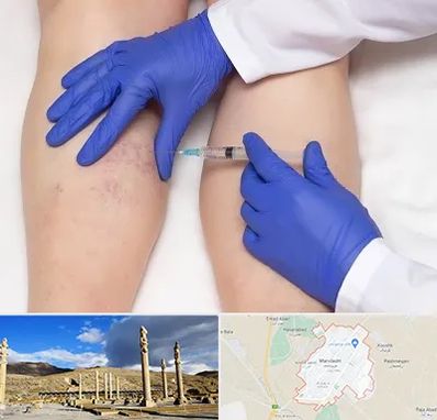 اسکلروتراپی در مرودشت