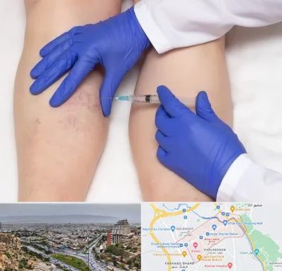 اسکلروتراپی در معالی آباد شیراز