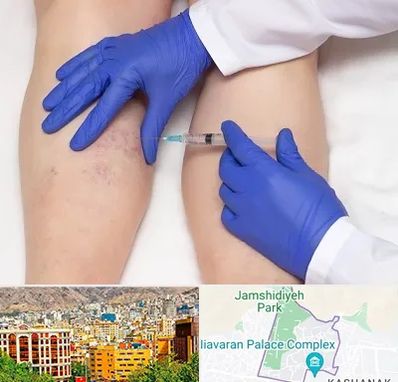 اسکلروتراپی در نیاوران 