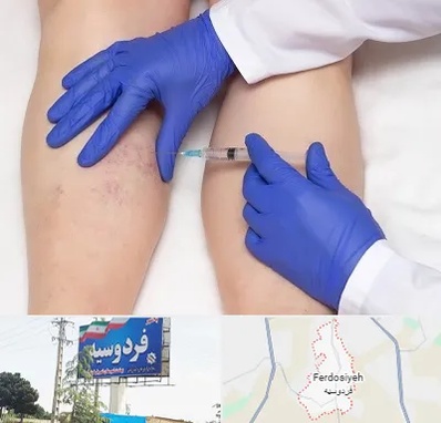 اسکلروتراپی در فردوسیه شهریار