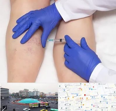 اسکلروتراپی در میدان انقلاب 