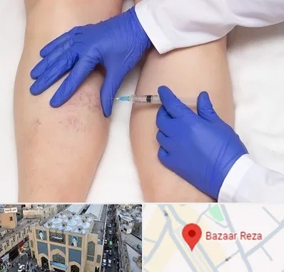اسکلروتراپی در بازار رضا مشهد