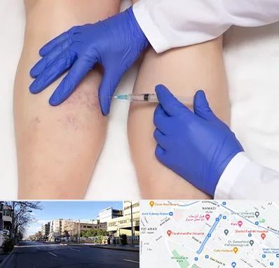 اسکلروتراپی در خیابان ملاصدرا شیراز