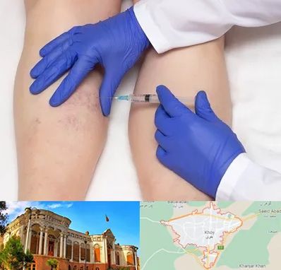 اسکلروتراپی در خوی