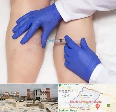 اسکلروتراپی در حکیمیه 