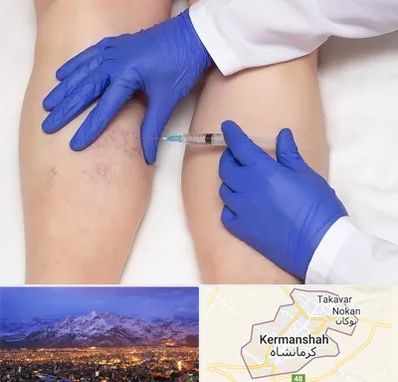 اسکلروتراپی در کرمانشاه