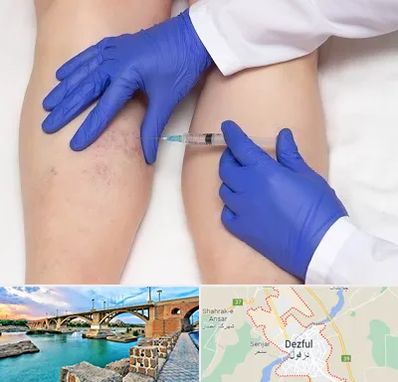 اسکلروتراپی در دزفول