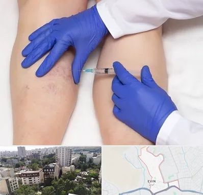 اسکلروتراپی در اوین