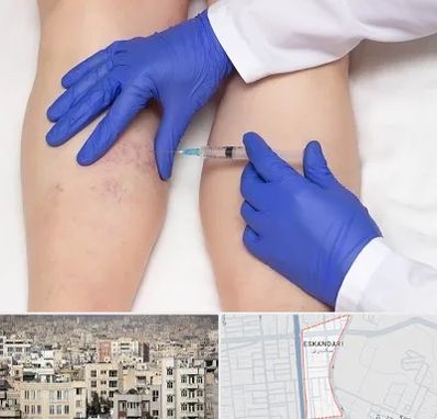 اسکلروتراپی در اسکندری