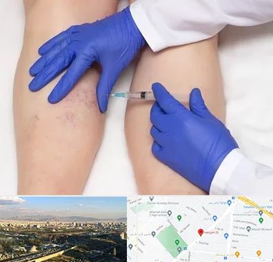 اسکلروتراپی در هنگام 