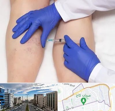 اسکلروتراپی در سعادت آباد 