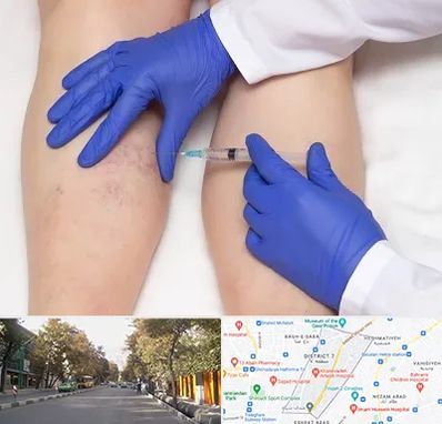 اسکلروتراپی در شریعتی 