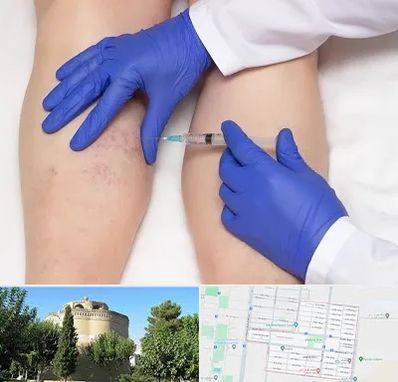 اسکلروتراپی در مرداویج اصفهان