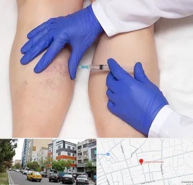 اسکلروتراپی در هفده شهریور تبریز