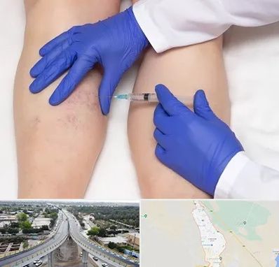 اسکلروتراپی در اندیمشک