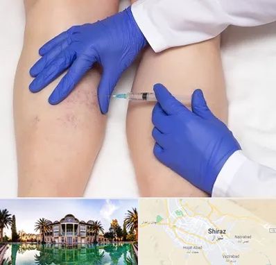 اسکلروتراپی در شیراز