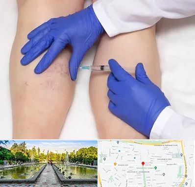 اسکلروتراپی در سرسبز 