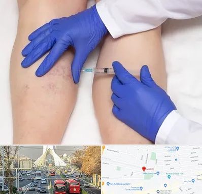 اسکلروتراپی در خیابان آزادی 