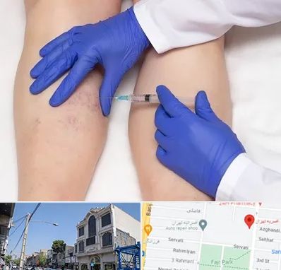 اسکلروتراپی در افسریه 