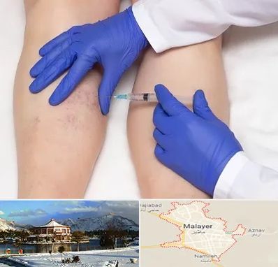 اسکلروتراپی در ملایر