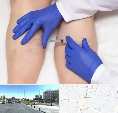 اسکلروتراپی در بلوار کلاهدوز مشهد 