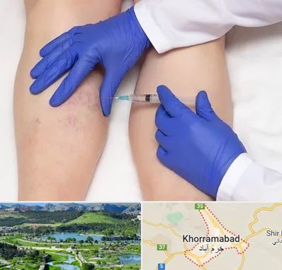 اسکلروتراپی در خرم آباد