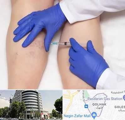 اسکلروتراپی در قلهک 