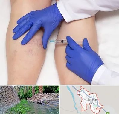 اسکلروتراپی در سراوان