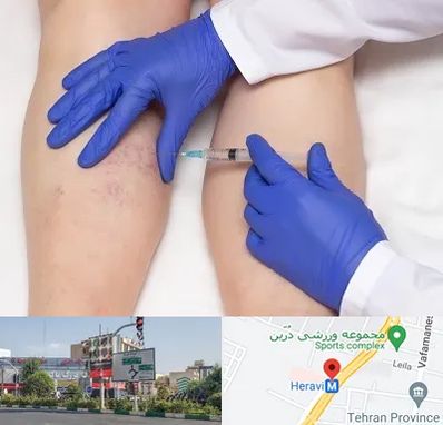 اسکلروتراپی در هروی 