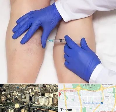 اسکلروتراپی در مرزداران 