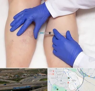 اسکلروتراپی در یاغچیان تبریز